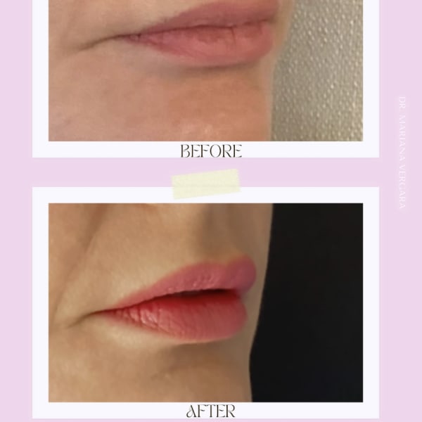 Before and After comparison of a Lip Flip