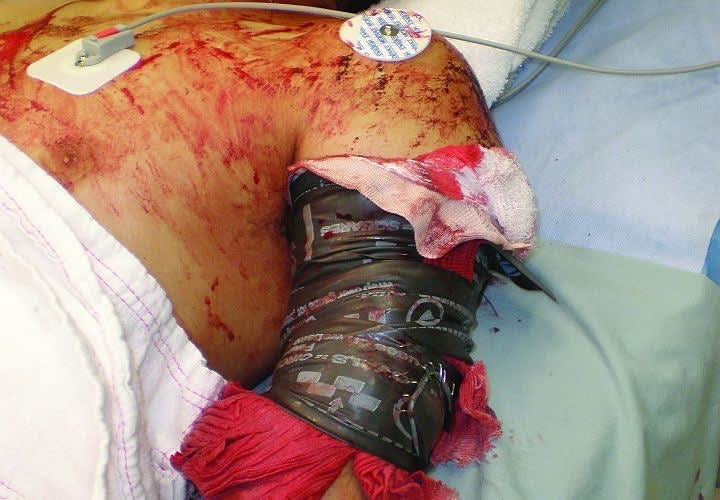Field Trauma Care for LEOs