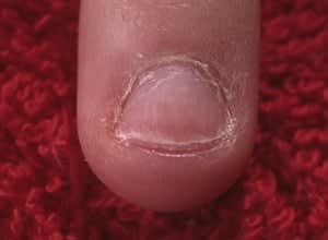 The nail biter's nail plate can be as little as one- quarter the size of  a normal plate. Another challenge is working around the puffy skin at  the tip of the finger. The puffiness can cause a tip to eventually pop  off, or may give a sculpted nail a remarkable resemblance to an M&M.