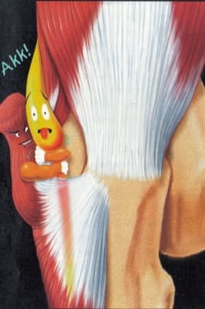The ulnar nerve (yellow) is one of three nerves that run from the neck to the hand. As the ulnar nerve travels through the elbow (as depicted in this cartoon illustration), it runs through the cubital tunnel, which is made from muscle, ligament, and bone (red). If the cubital tunnel is irritated, it can swell.