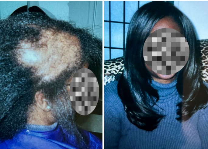 before and after of client with net method hair replacement
