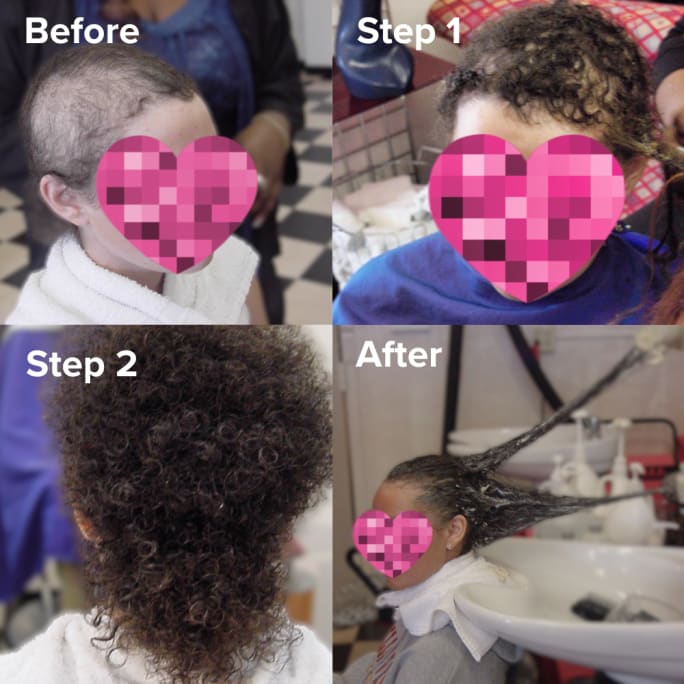 before and after of client with net method hair replacement
