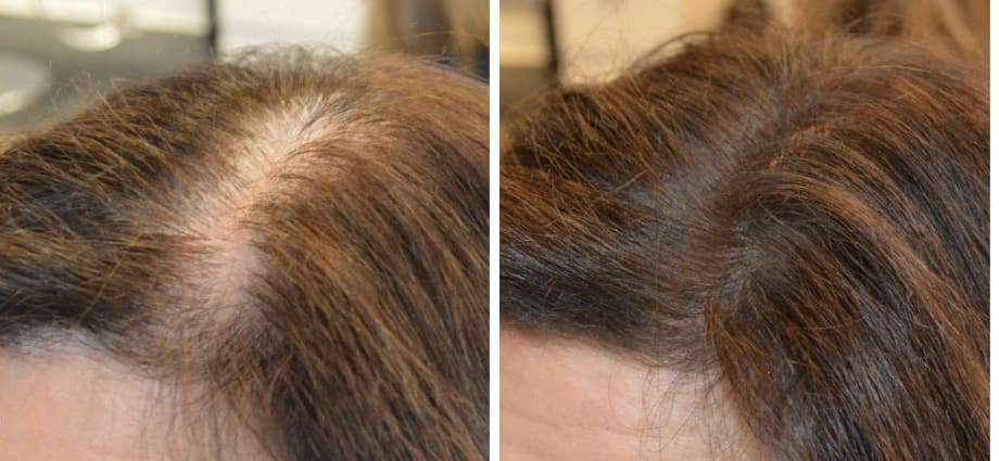 Why Women Lose Hair And How You Can Help