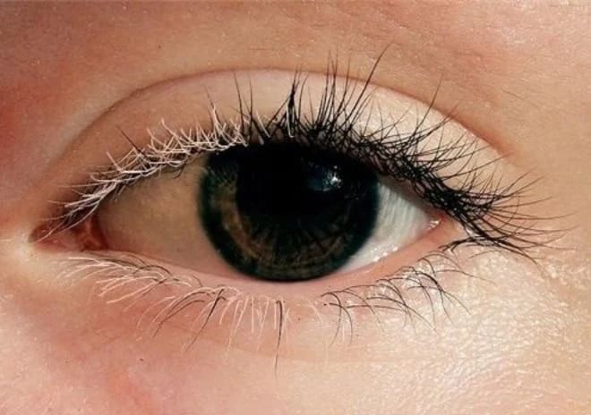 Rare Hair Condition Creates "Mallen Streak" -- A Higlighted Streak You're Born With