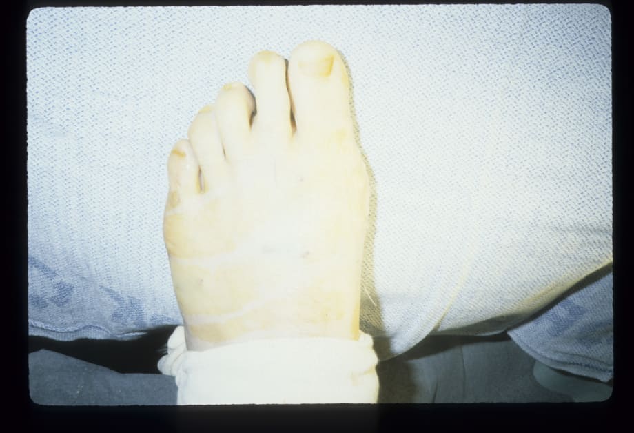 A Podiatrist’s Guide to Bunion Surgery