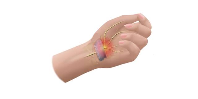Carpal Tunnel: Take Matters Into Your Own Hands