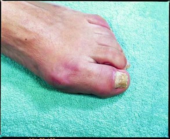 LCN Pedique Plus Toenail Rebuild