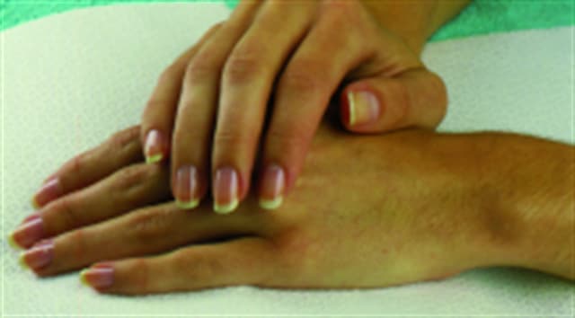 What You Need to Know About Ganglion Cysts