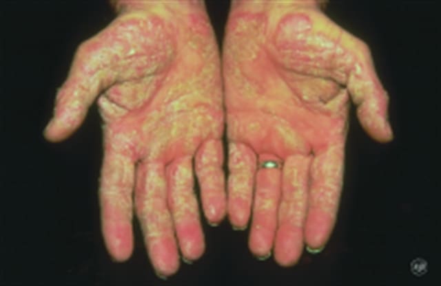 What Is Psoriasis?
