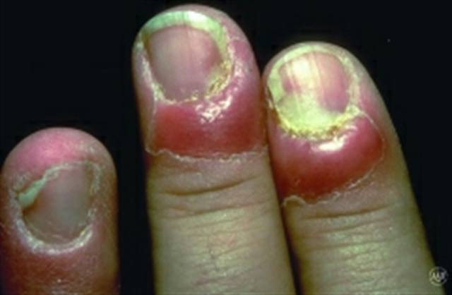 What Is Paronychia?