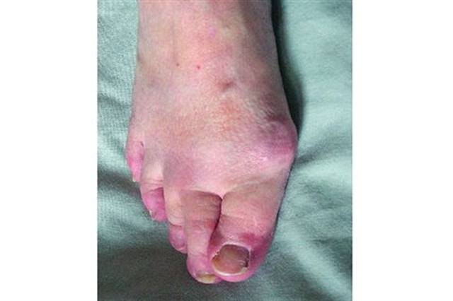What Are Bunions?