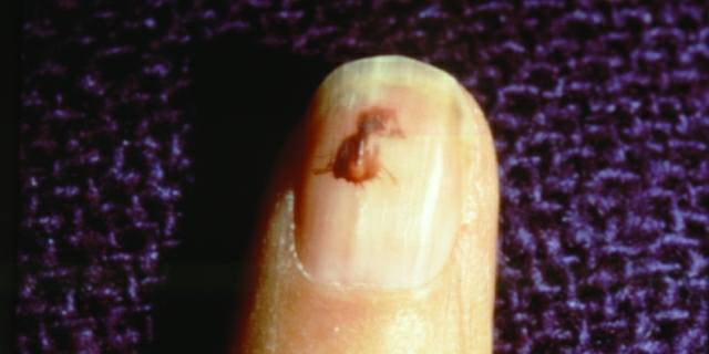 What Is a Splinter Hemorrhage?