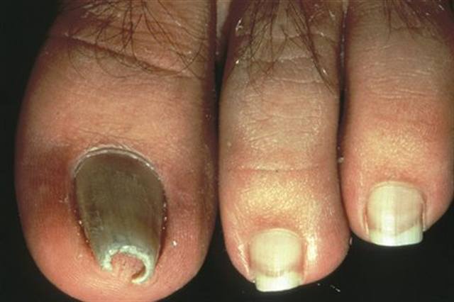 What Are Pincer Nails?