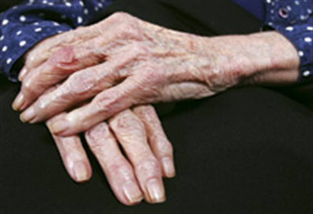 What Is Arthritis Pain?
