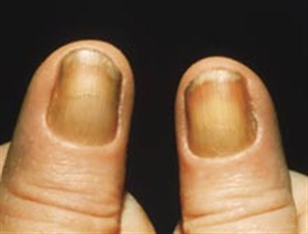 What Is Yellow Nail Syndrome?