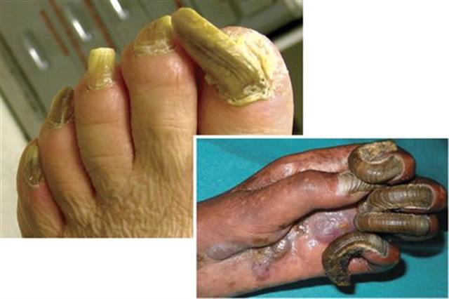 What Is Onychogryphosis?
