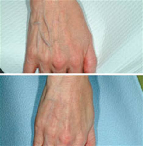 Sclerotherapy Improves the Look of Aging Hands