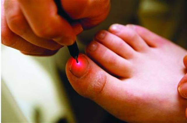 Laser Fungal Treatment Twice as Effective as Pills