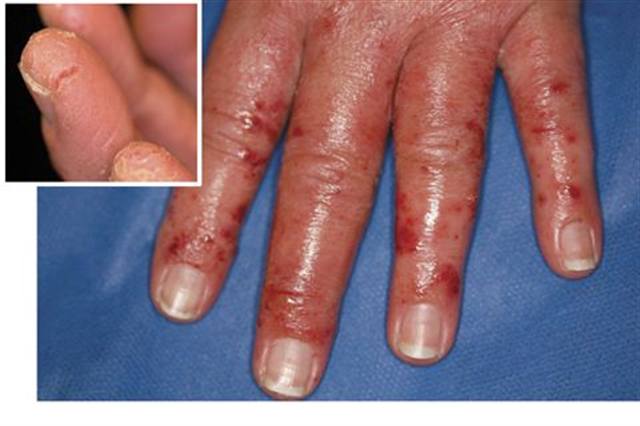 What Is Allergic Contact Dermatitis?