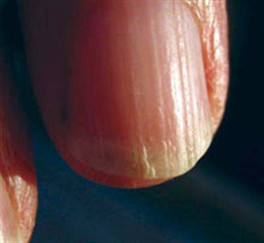 What Is Onychorrhexis?