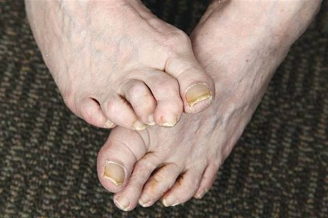 What Is Hammertoe?