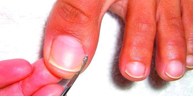 You’re Never Alone When a Nail’s Ingrown