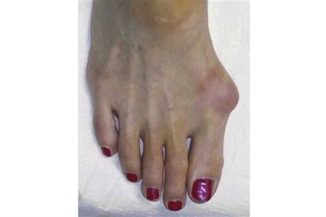 What Are Neuromas?
