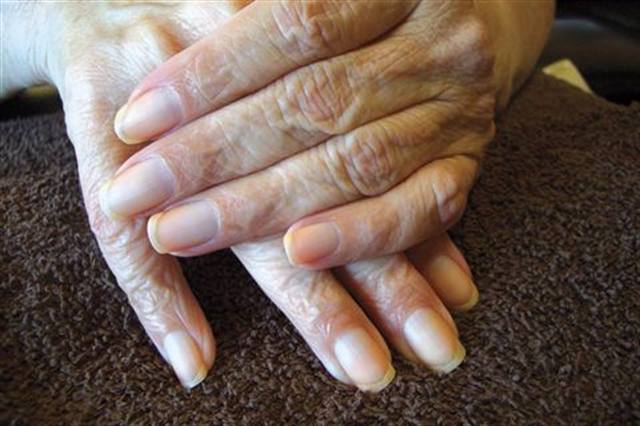 Diagnosing Different Nail Types
