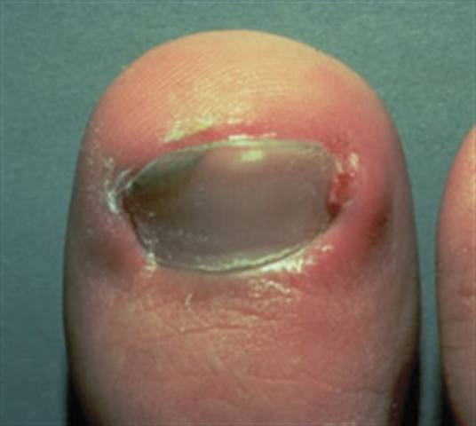 What Are Ingrown Nails?