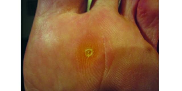 What Are Plantar Warts?
