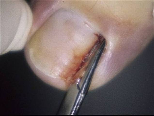 A Doctor's Notes on Ingrown Toenail Surgery