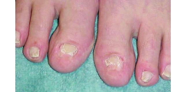 Reconstructing Damaged Toenails