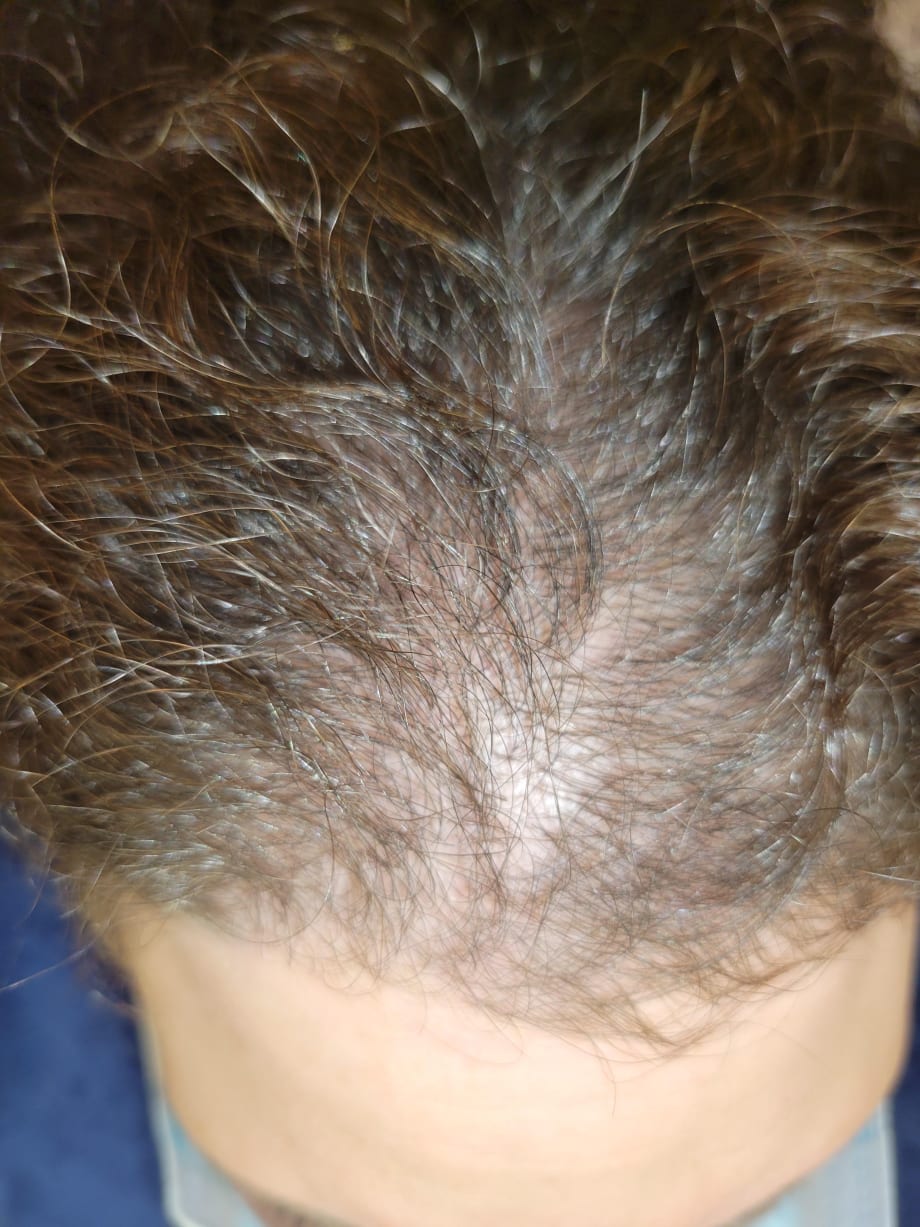 Micro Point Links Create Hair Volume on Top 