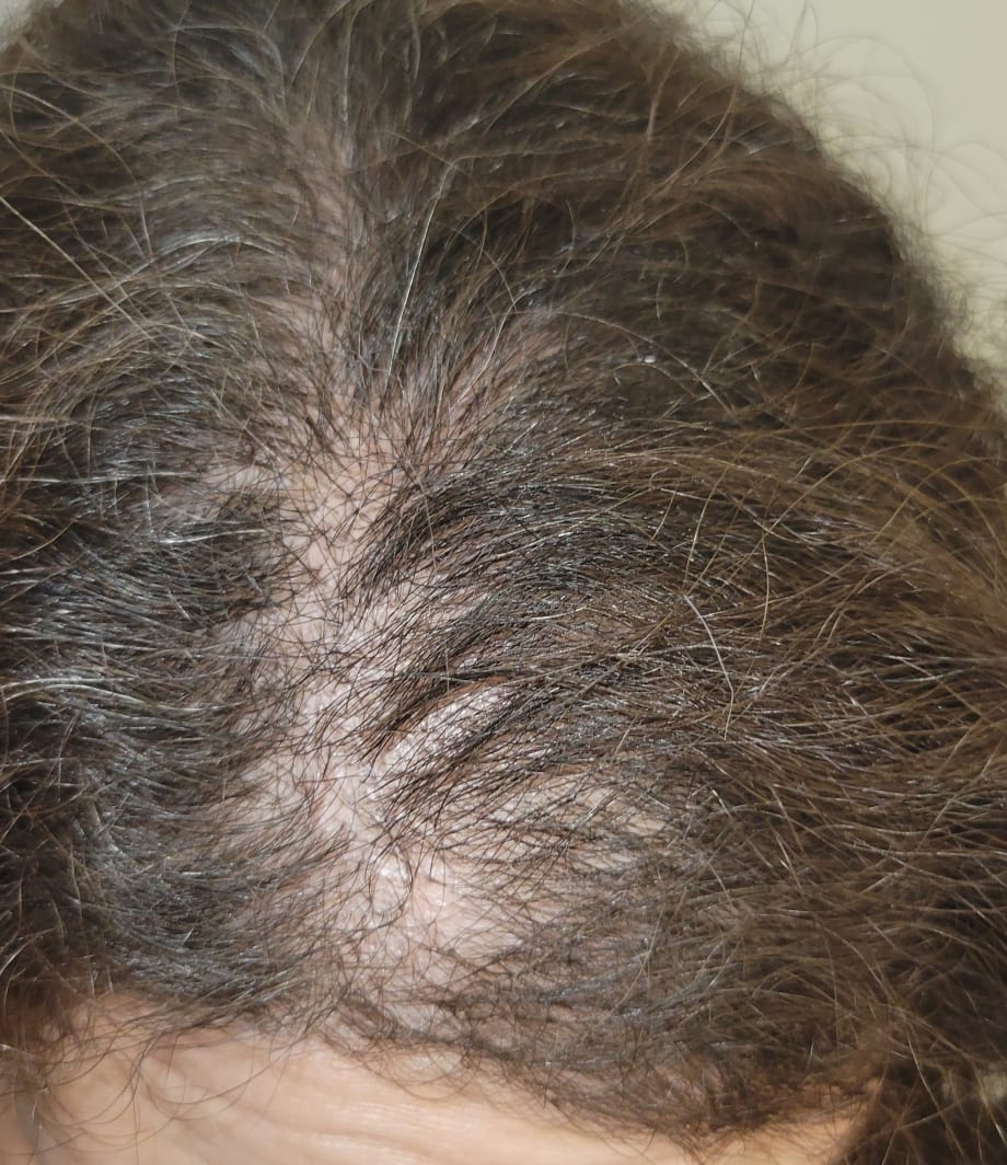 Micro Point Links Create Hair Volume on Top 