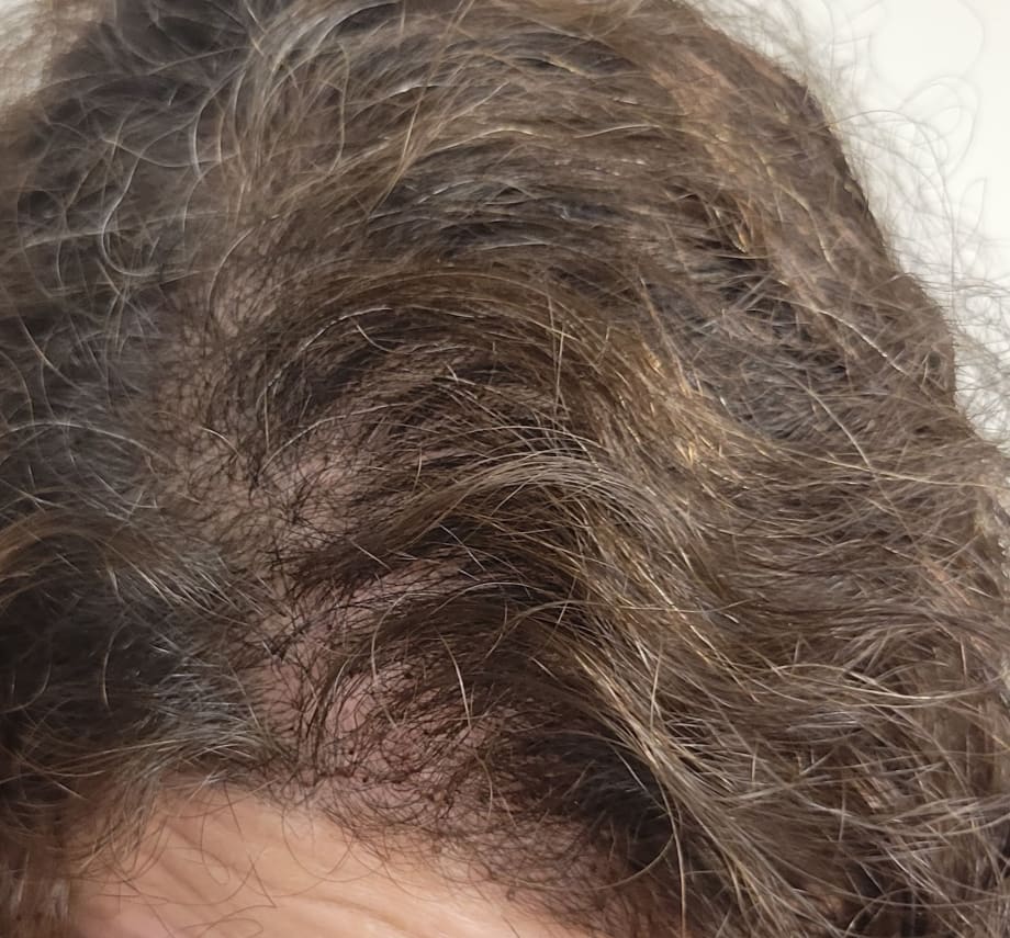 Micro Point Links Create Hair Volume on Top 