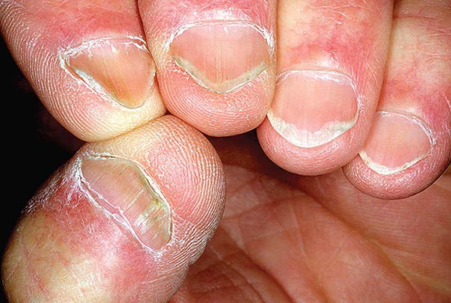 What Are Spoon Nails?