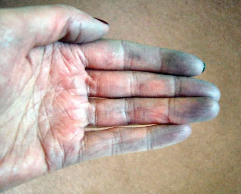 What Is Raynaud's Disease?