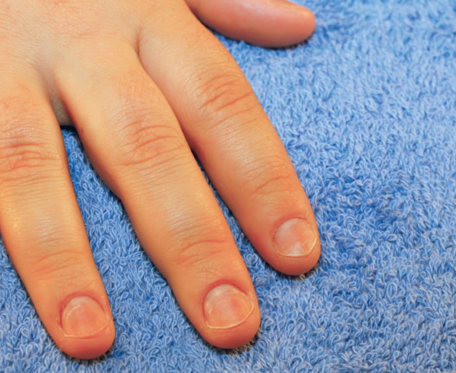 Nail Cravings: Fixing Bitten Mittens