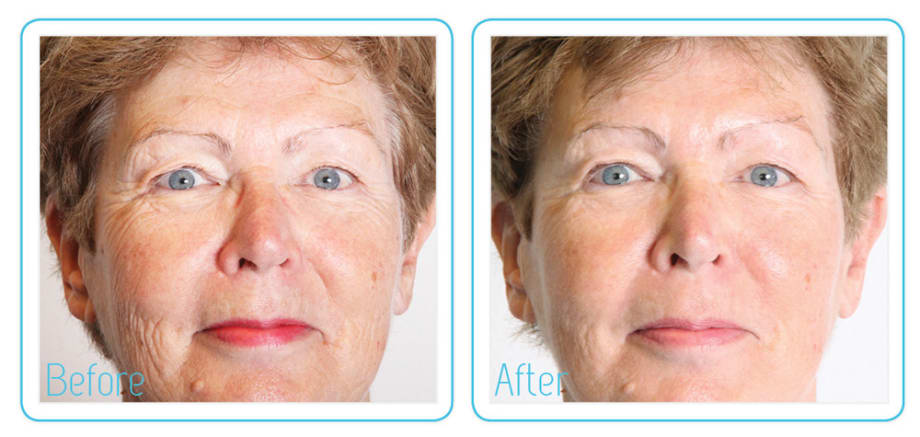 The Anti-Vampire Facelift