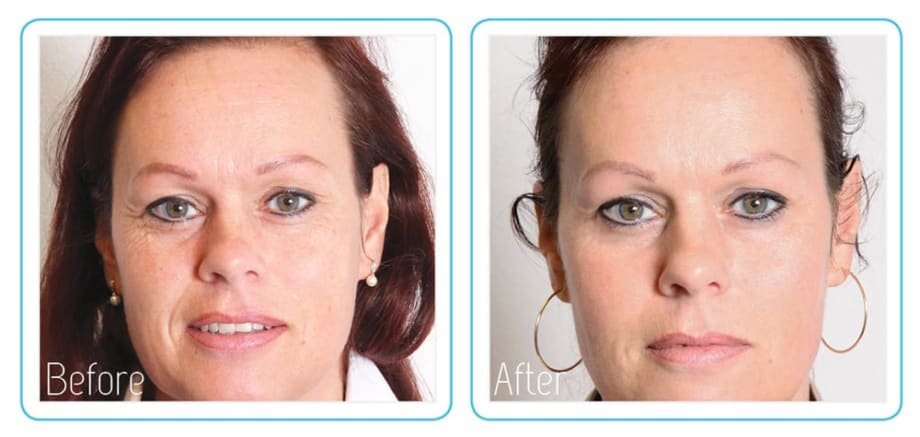 The Anti-Vampire Facelift