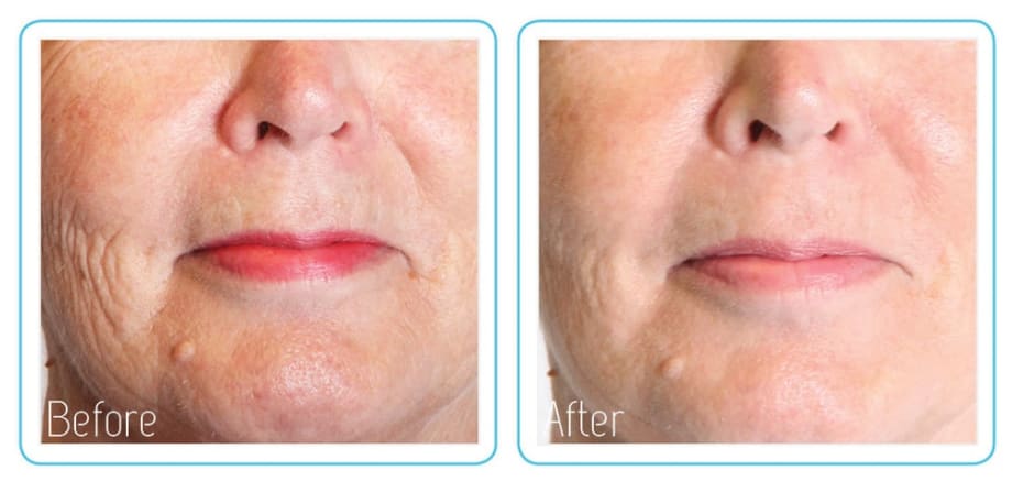 The Anti-Vampire Facelift