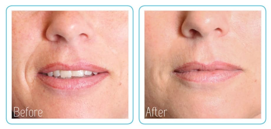 The Anti-Vampire Facelift