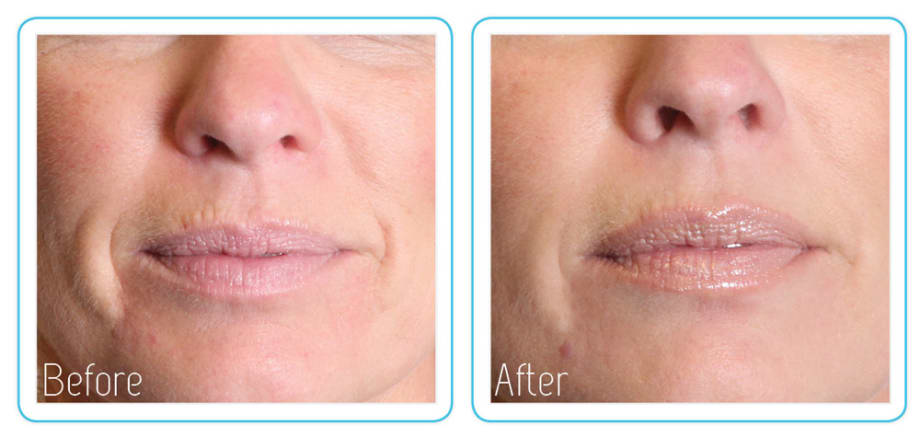 The Anti-Vampire Facelift