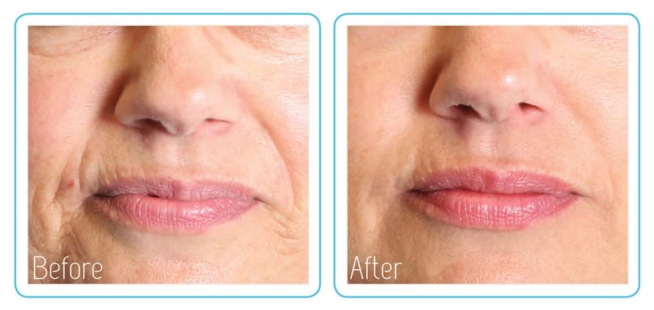 The Anti-Vampire Facelift