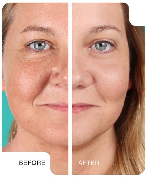 The Anti-Vampire Facelift