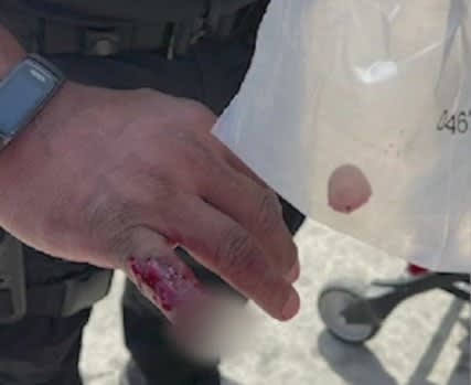 Homeless Man Bites Off LAPD Officer’s Finger