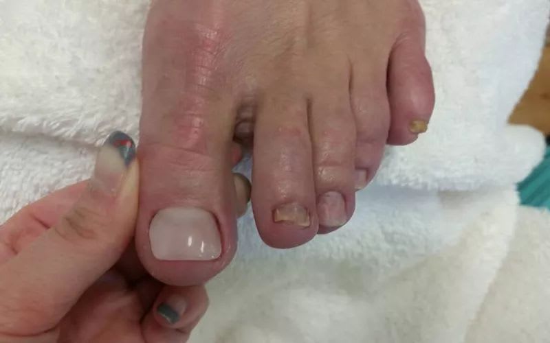 Cover Up Fungal Nails With the KeryFlex Nail Restoration System