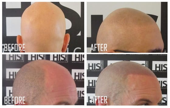 NEW TREND: Tattooing "Hair" onto the Head -- A Solution for Baldness?