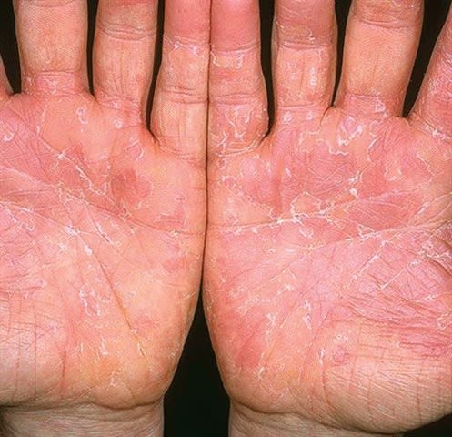 Health: What Is Exfoliative Keratolysis?