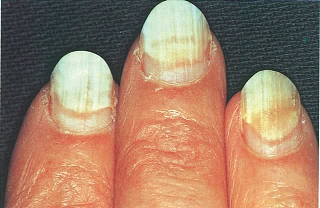 When Nails Separate
